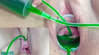 Cervix and Pee Hole Inflation with Injections for Japanese Lesbians